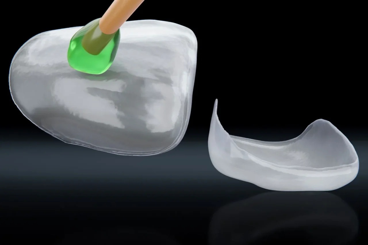 Emax 3D Veneer
